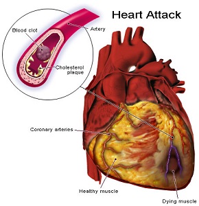 Heart disease