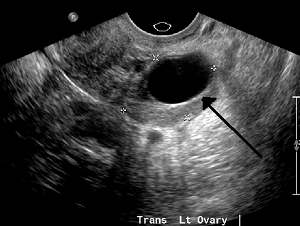 Ovarian Cysts