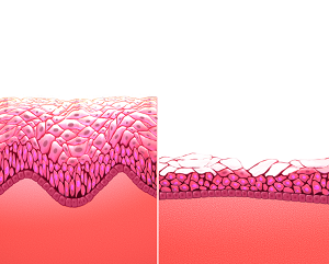 Thinning Of The Vaginal Walls