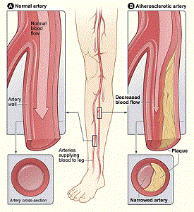 Claudication