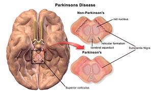 Parkinson's Disease