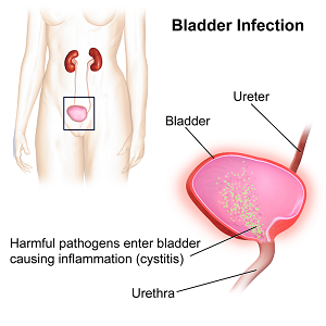 Urinary infections