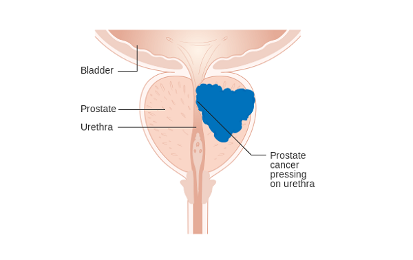 prostate cancer